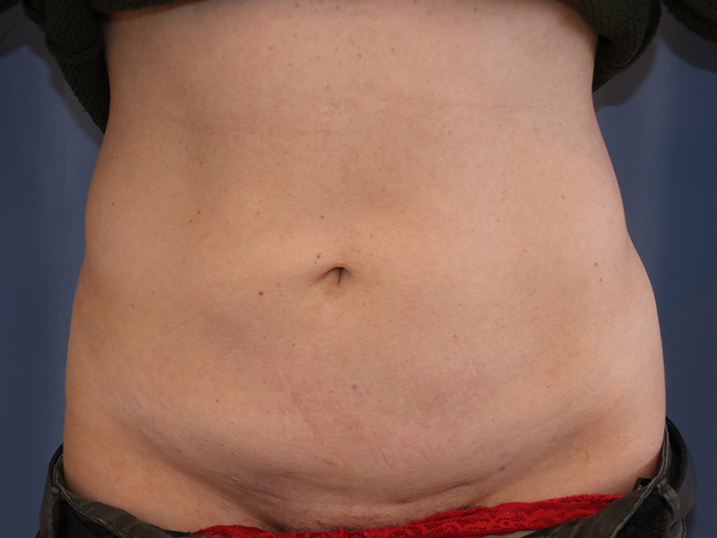 Tummy-Tuck-Case--11 | Before Tummy Tuck