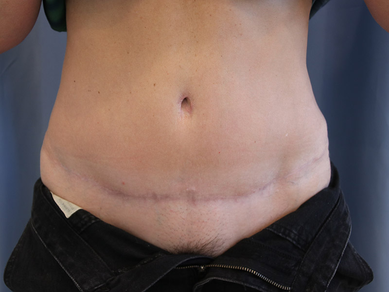 Tummy-Tuck-Case--12 | After Tummy Tuck