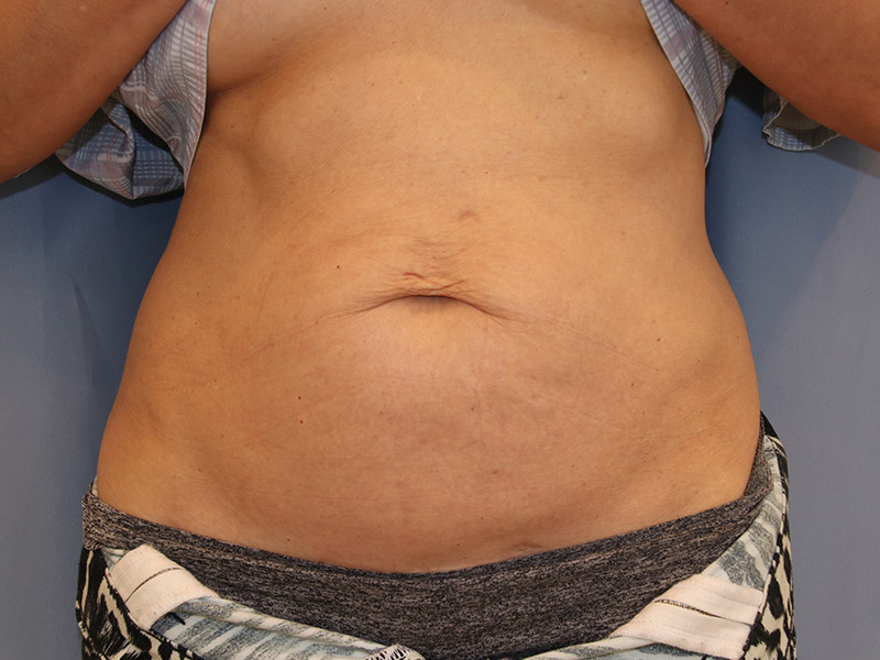 Tummy-Tuck-Case--13 | Before Tummy Tuck