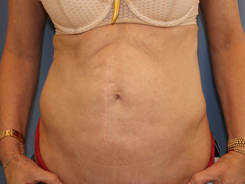 Tummy-Tuck-Case--14 | Before Tummy Tuck
