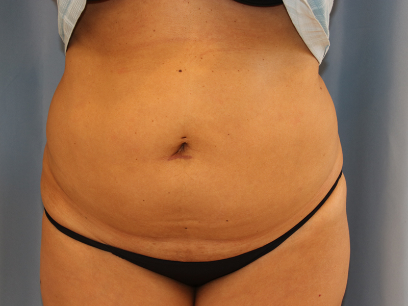 Tummy-Tuck-Case--16 | Before Tummy Tuck