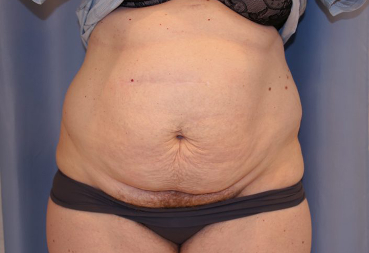 Tummy-Tuck-Case--20 | Before Tummy Tuck