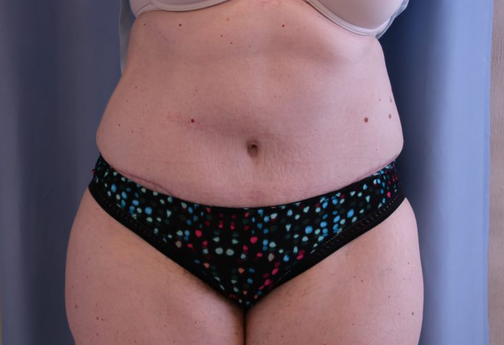 Tummy-Tuck-Case--20 | After Tummy Tuck