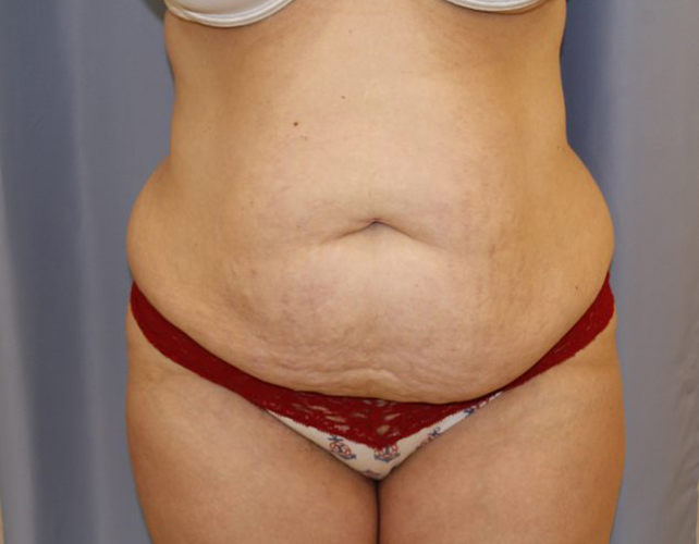 Tummy-Tuck-Case--21 | Before Tummy Tuck