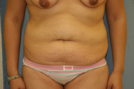 Tummy-Tuck-Case--23 | Before Tummy Tuck