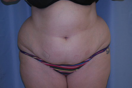 Tummy-Tuck-Case--24 | Before Tummy Tuck
