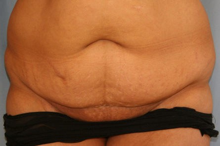 Tummy-Tuck-Case--27 | Before Tummy Tuck