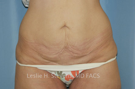 Case--4193 | Before Tummy Tuck