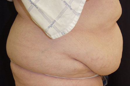 Tummy-Tuck-Case--31 | Before Tummy Tuck