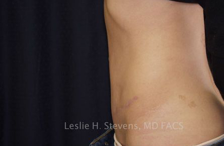 Tummy-Tuck-Case--32 | After Tummy Tuck