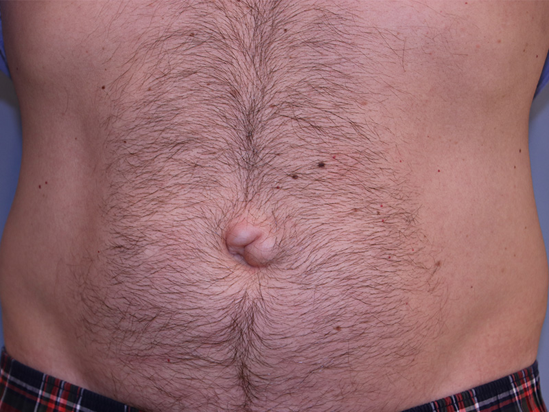 Umbilicoplasty-Case--01 | Before Umbilicoplasty