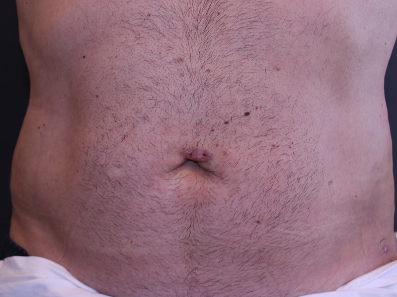 Umbilicoplasty-Case--01 | After Umbilicoplasty