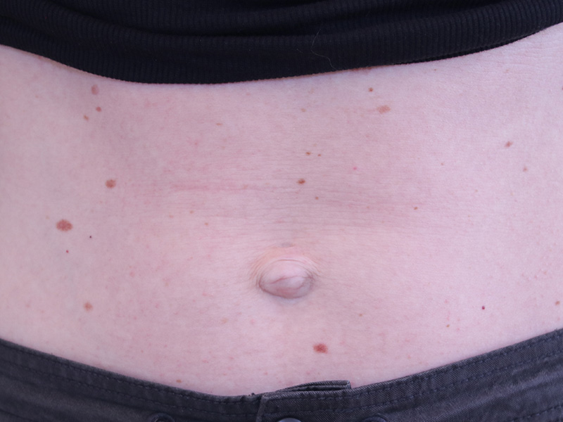 Umbilicoplasty-Case--02 | Before Umbilicoplasty