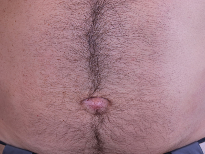 Umbilicoplasty-Case--03 | Before Umbilicoplasty