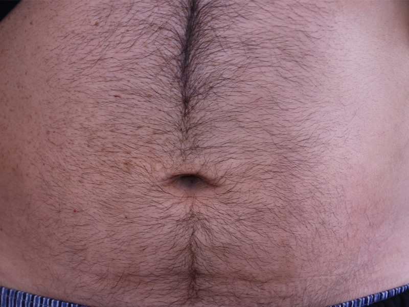 Umbilicoplasty-Case--03 | After Umbilicoplasty