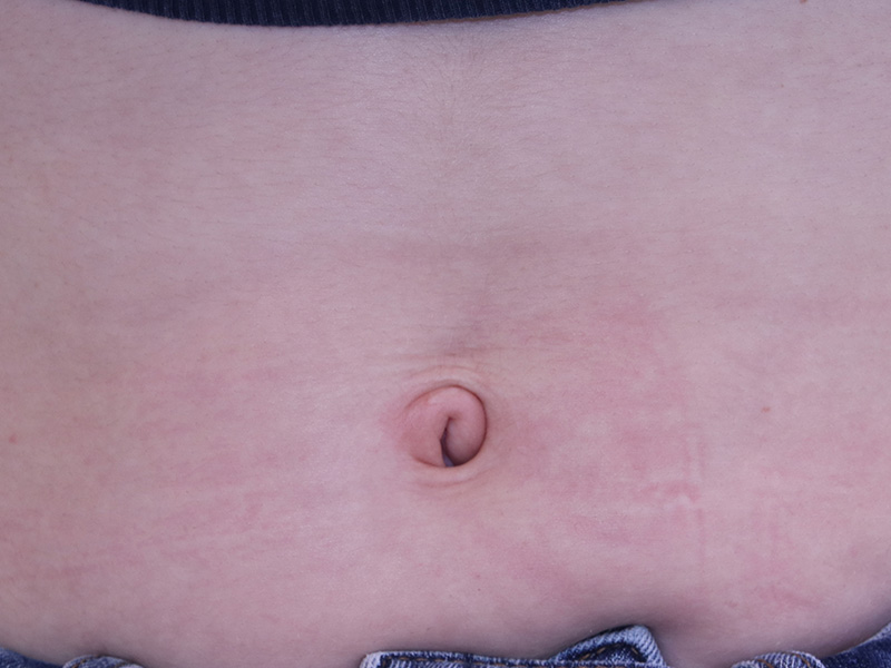 Umbilicoplasty-Case--04 | Before Umbilicoplasty