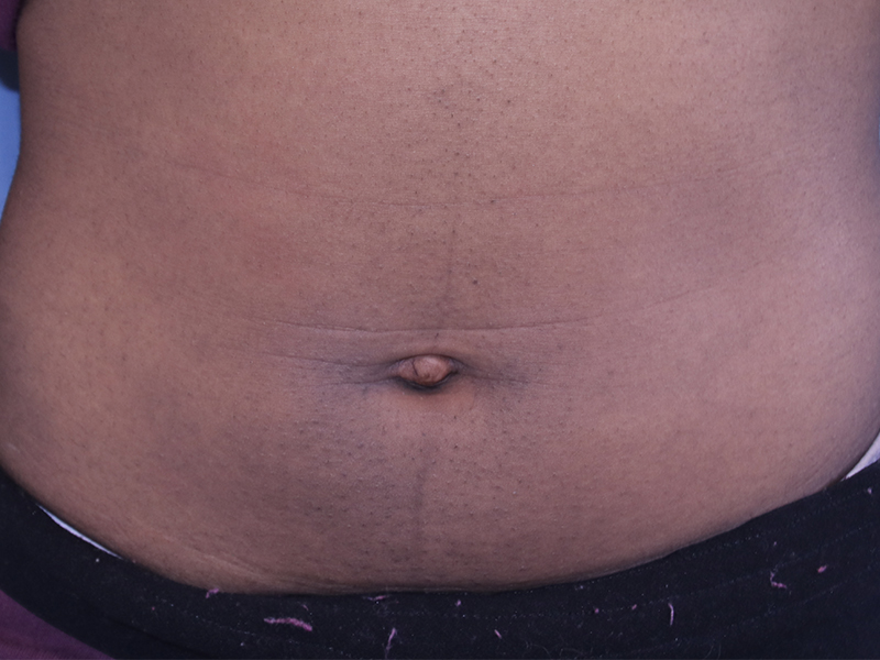 Umbilicoplasty-Case--06 | Before Umbilicoplasty