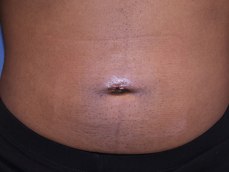 Umbilicoplasty-Case--06 | After Umbilicoplasty