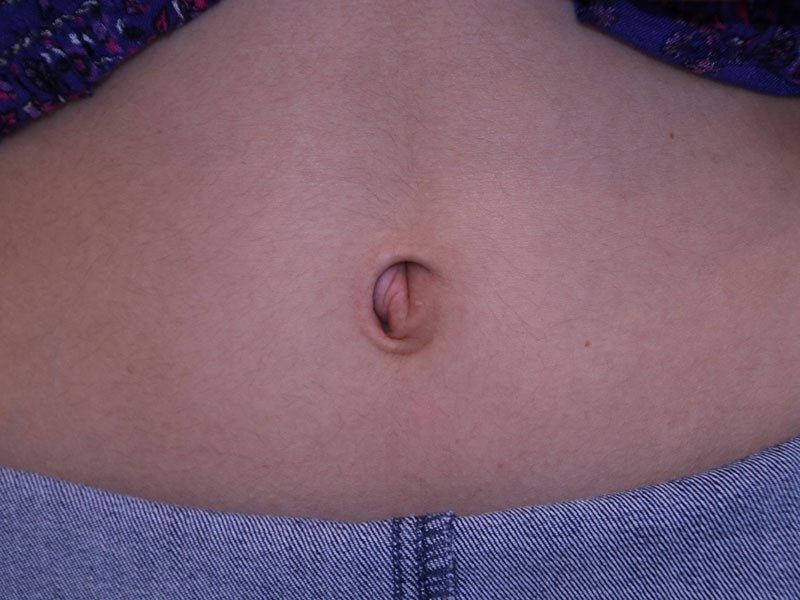Umbilicoplasty-Case--08 | Before Umbilicoplasty