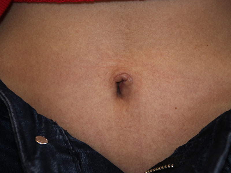 Umbilicoplasty-Case--08 | After Umbilicoplasty