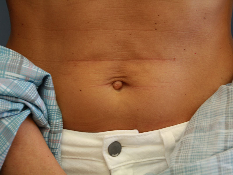 Umbilicoplasty-Case--09 | Before Umbilicoplasty