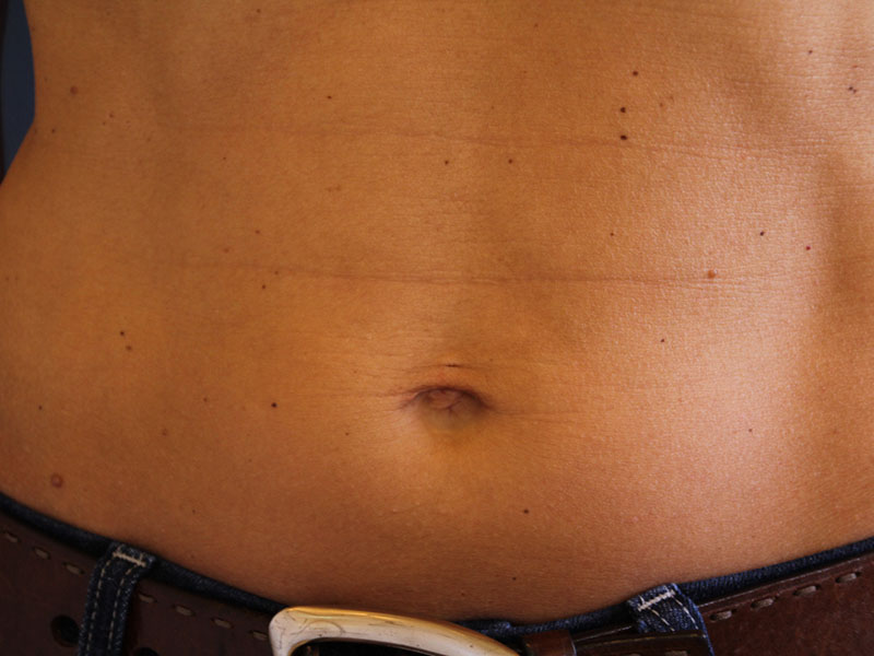 Umbilicoplasty-Case--09 | After Umbilicoplasty