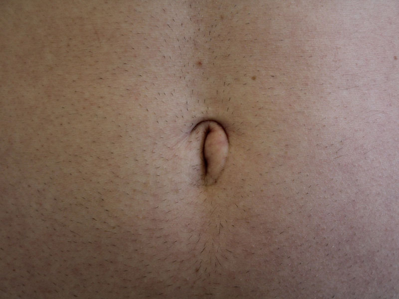 Umbilicoplasty-Case--10 | Before Umbilicoplasty