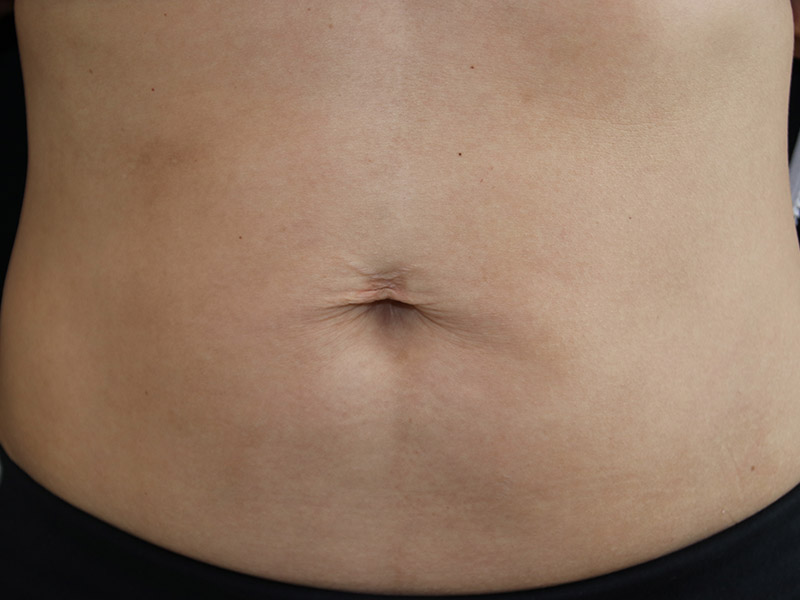 Umbilicoplasty-Case--13 | Before Umbilicoplasty