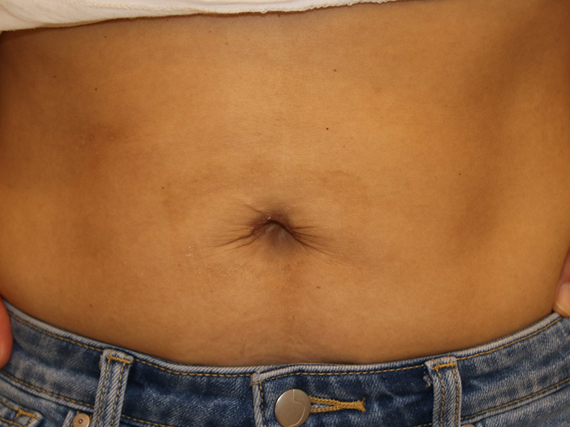 Umbilicoplasty-Case--13 | After Umbilicoplasty