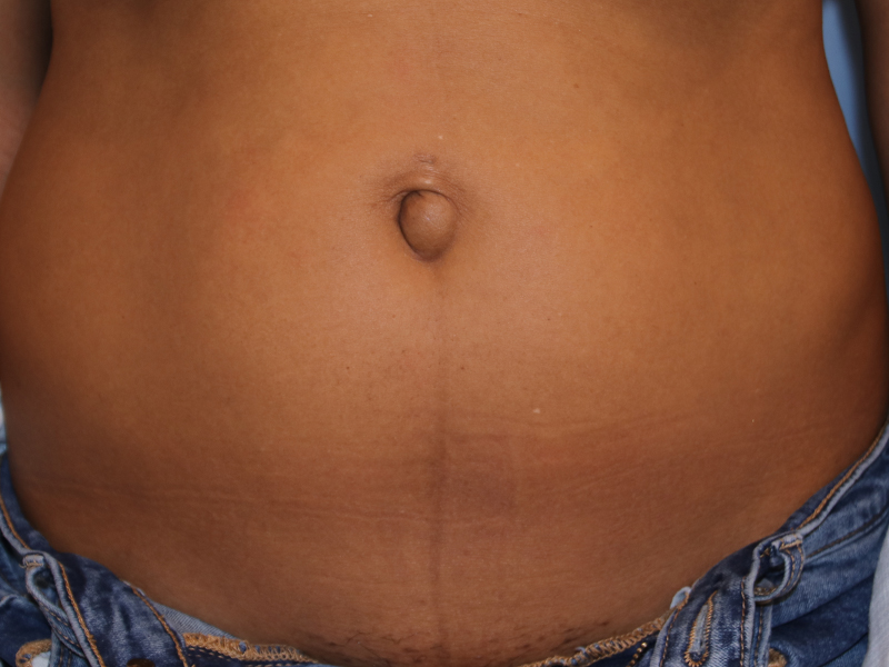 Tummy-Tuck-Case--34 | Before Tummy Tuck