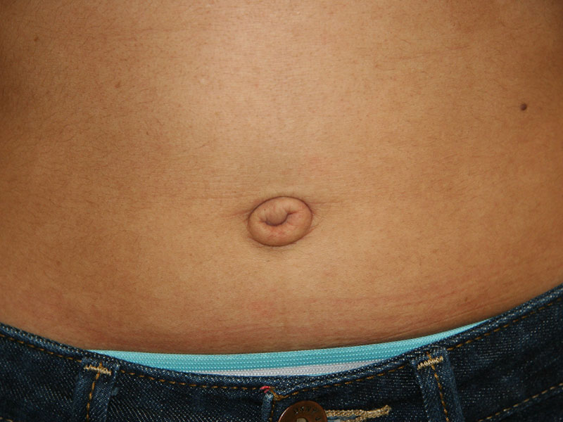 Umbilicoplasty-Case--17 | Before Umbilicoplasty