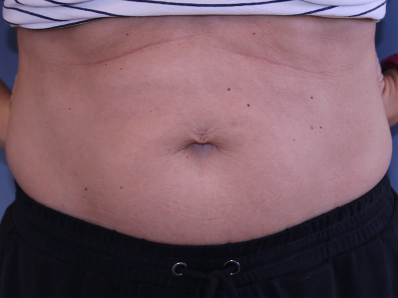 Case--3574 | Before Umbilicoplasty